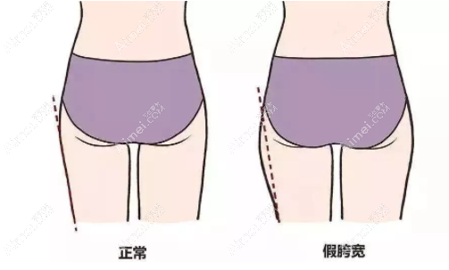 盆骨修复可以改善假胯宽吗? 盆骨修复可以改善假胯宽吗?