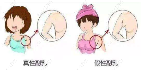 真性副乳和假性副乳 真性副乳和假性副乳