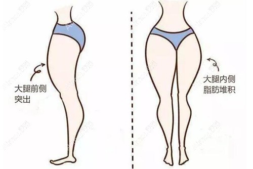 大腿特别粗怎么才能瘦下来,瘦大腿除了抽脂还有其他办法