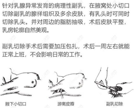 副乳切除手术过程图示 副乳切除手术过程图示