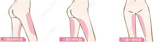 大腿吸脂的位置 大腿吸脂的位置