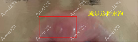 玻尿酸丰唇后起泡了怎么办 玻尿酸丰唇后起泡了怎么办