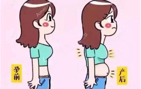 假胯宽吸脂 假胯宽吸脂