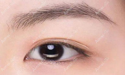 双眼皮贴长期贴会导致眼皮下垂吗? 双眼皮贴长期贴会导致眼皮下垂吗?
