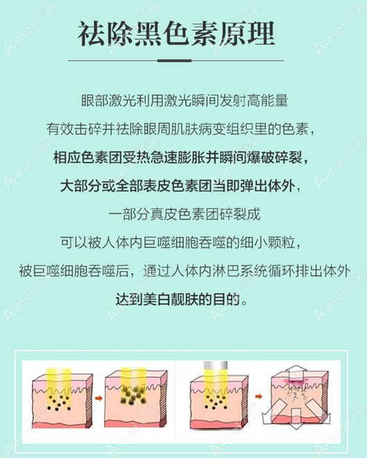 激光去黑眼圈的原理 激光去黑眼圈的原理