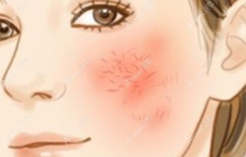 莫名其妙的脸好烫好红怎么回事?脸发红发烫有啥方法能改善?