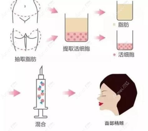 自体脂肪面雕手术做法过程 自体脂肪面雕手术做法过程