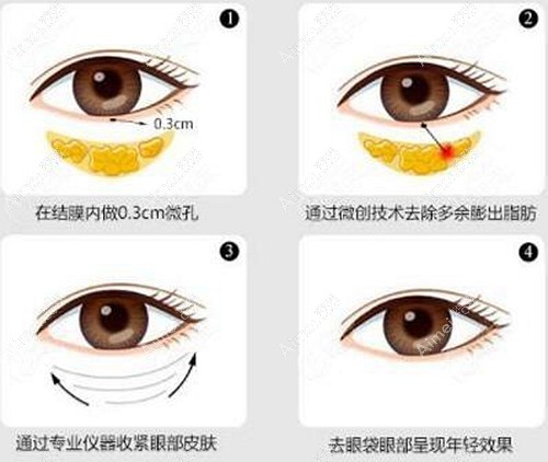 不开刀祛眼袋手术过程 不开刀祛眼袋手术过程