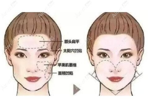 自体脂肪面雕手术对比照 自体脂肪面雕手术对比照