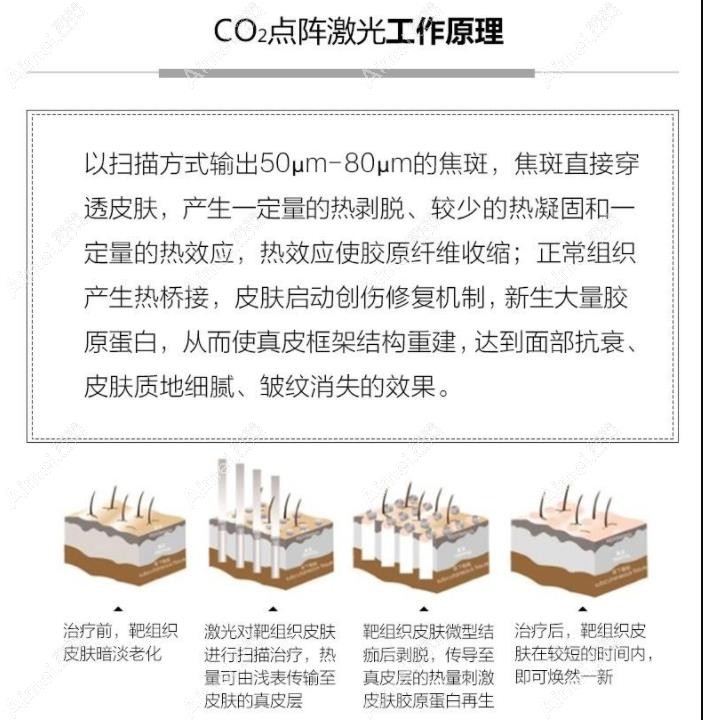 点阵激光祛法令纹原理图 点阵激光祛法令纹原理图