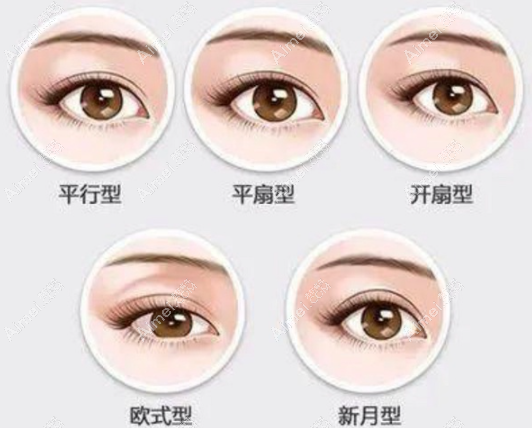双眼皮的类型 双眼皮的类型