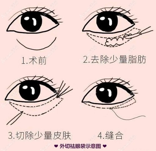 外切去眼袋手术过程 外切去眼袋手术过程