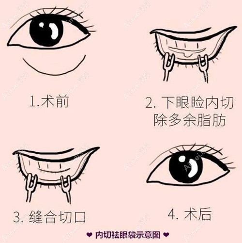 内切祛眼袋手术过程 内切祛眼袋手术过程