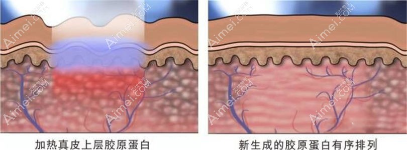点阵激光去烟疤 点阵激光去烟疤