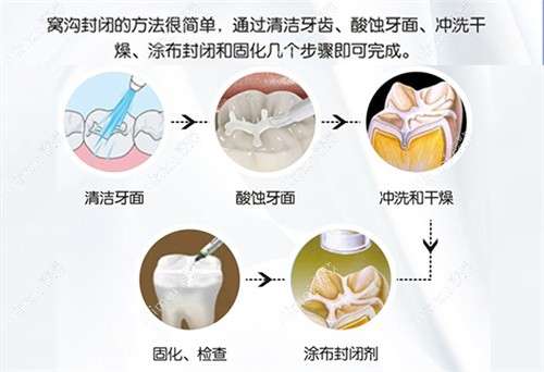 儿童牙齿窝沟封闭多少钱一颗 儿童牙齿窝沟封闭多少钱一颗