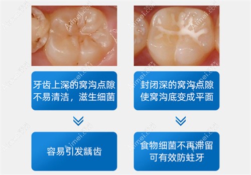 儿童牙齿窝沟封闭的作用 儿童牙齿窝沟封闭的作用