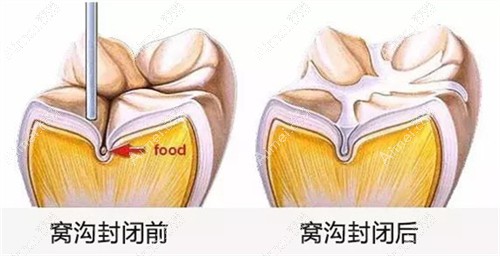 窝沟封闭是长一颗做一颗吗 窝沟封闭是长一颗做一颗吗