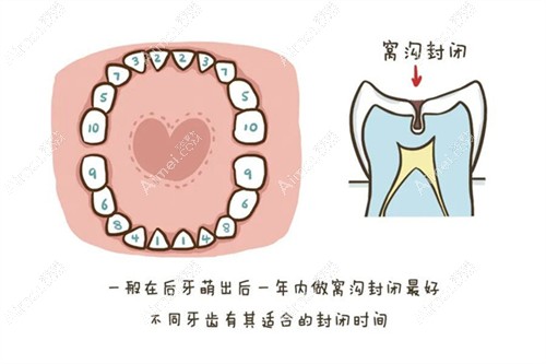 儿童牙齿窝沟封闭是几颗牙一起做 儿童牙齿窝沟封闭是几颗牙一起做