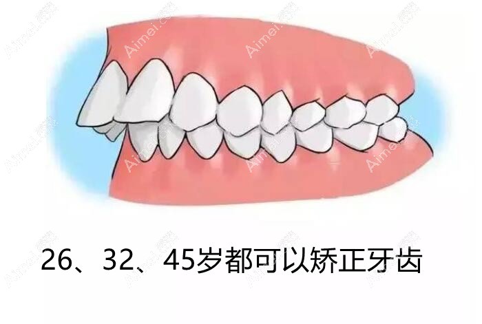 矫正牙齿没有年龄限制 矫正牙齿没有年龄限制