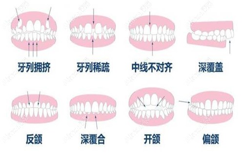 30岁矫正牙齿会不会有影响?牙齿正畸是没有年龄限制的