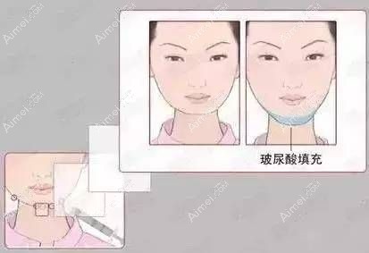 注射玻尿酸出现嘴歪等待消肿期后一般可恢复自然.jpg