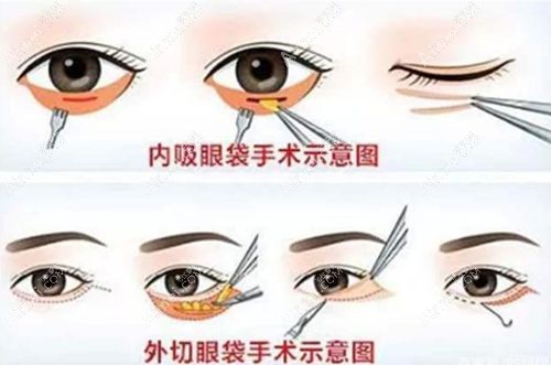 去眼袋手术相比生姜片去眼袋大.jpg 去眼袋手术相比生姜片去眼袋大.jpg