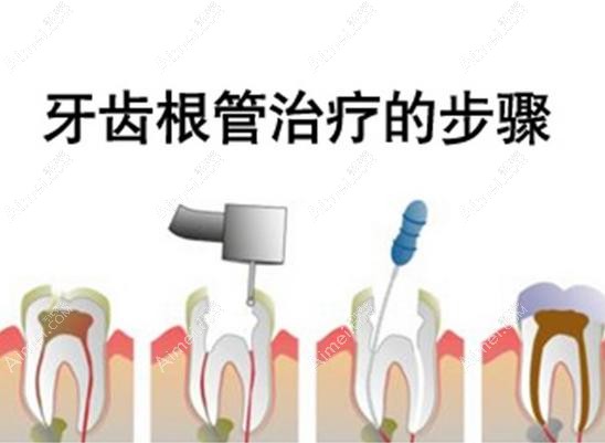 根管治疗的步骤 根管治疗的步骤