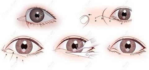 开眼角手术过程 开眼角手术过程