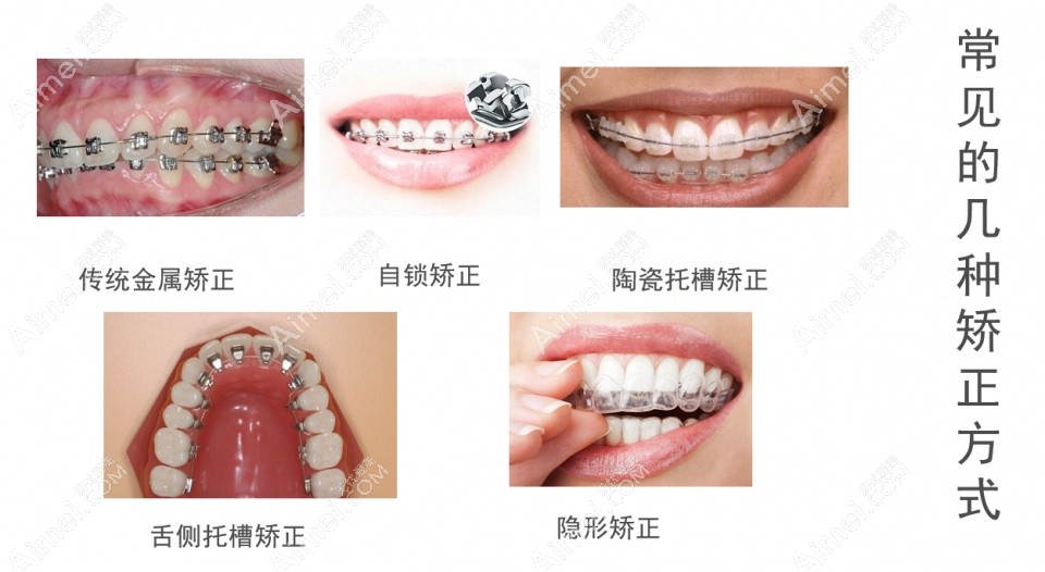 常用的牙齿矫正器类型 常用的牙齿矫正器类型