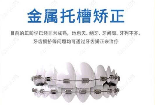金属矫正器优势 金属矫正器优势