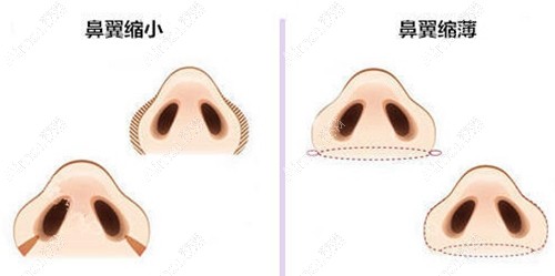 鼻翼缩小的部位 鼻翼缩小的部位