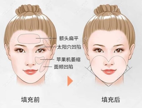 自体脂肪填充全脸是永久的吗?面部脂肪填充能管几年看这里