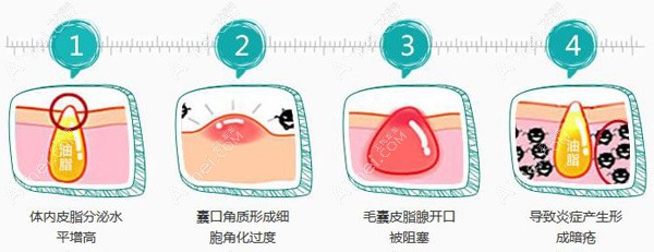 为什么会有青春痘 为什么会有青春痘