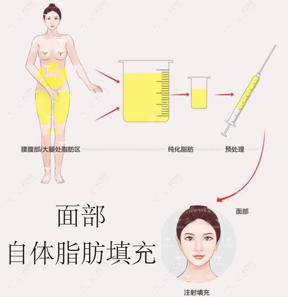 自体脂肪填充脸部过程 自体脂肪填充脸部过程