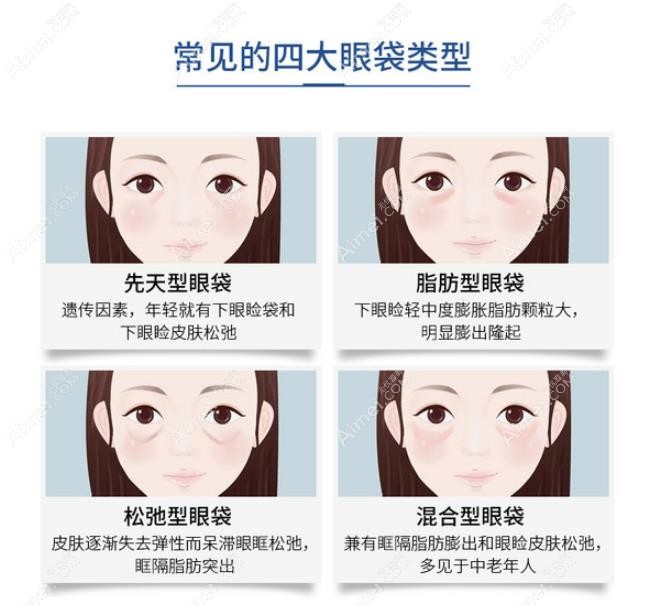 常见的眼袋类型有哪些 常见的眼袋类型有哪些