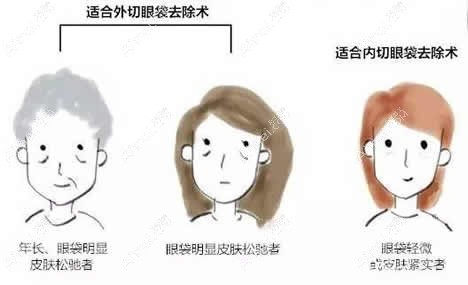 外切和内切祛眼袋适合的人群不一样 外切和内切祛眼袋适合的人群不一样