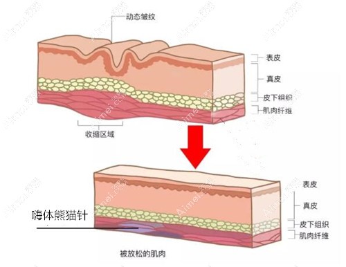 嗨体熊猫针填充法令纹作用 嗨体熊猫针填充法令纹作用