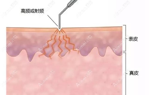哪里能点痣？找个正规的地方做激光点痣多少钱