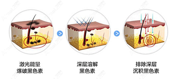 二氧化碳激光点痣原理 二氧化碳激光点痣原理