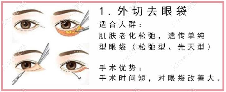 40岁男人有脂肪大眼袋做外切去眼袋比较好 40岁男人有脂肪大眼袋做外切去眼袋比较好