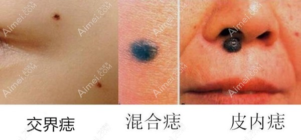 激光点痣的类型 激光点痣的类型