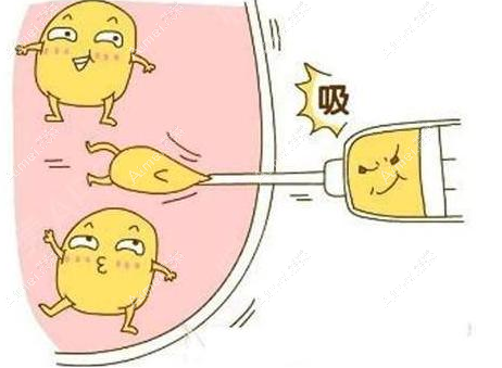 抽脂1个月才能开始性生活 抽脂1个月才能开始性生活