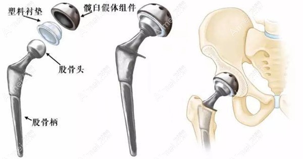陶瓷髋关节置换手术过程 陶瓷髋关节置换手术过程