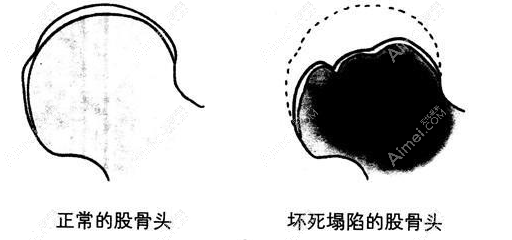 股骨头坏死做置换手术 股骨头坏死做置换手术