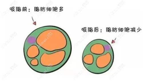 吸脂手术对脂肪细胞的作用 吸脂手术对脂肪细胞的作用