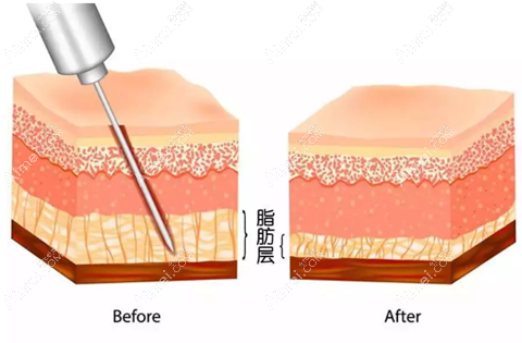 胯部做腰腹吸脂的原理 胯部做腰腹吸脂的原理