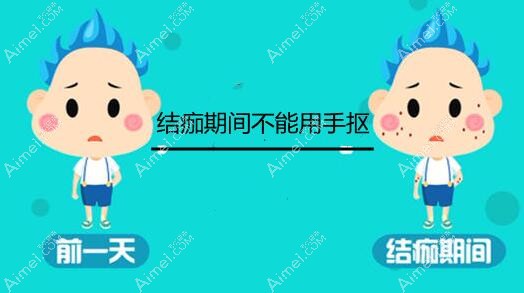 结痂期间用手抠的坏处说明 结痂期间用手抠的坏处说明
