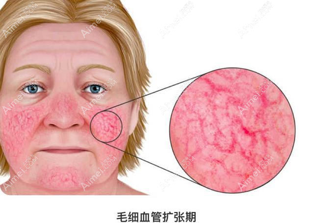 脸部玫瑰痤疮最佳治疗方法是涂抹药膏还是激光？