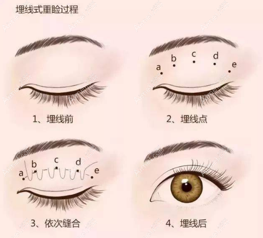 埋线双眼皮20年还能拆线,不管埋线10年还是30都可以拆掉埋线