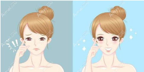 双眼皮和埋线双眼皮的区别 双眼皮和埋线双眼皮的区别